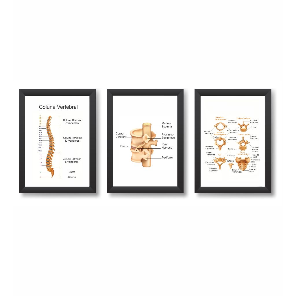 Kit 3 Quadros Decorativos Coluna Vertebral Fisioterapia Ortopedia Molduras 20x30cm Madeira Vidro