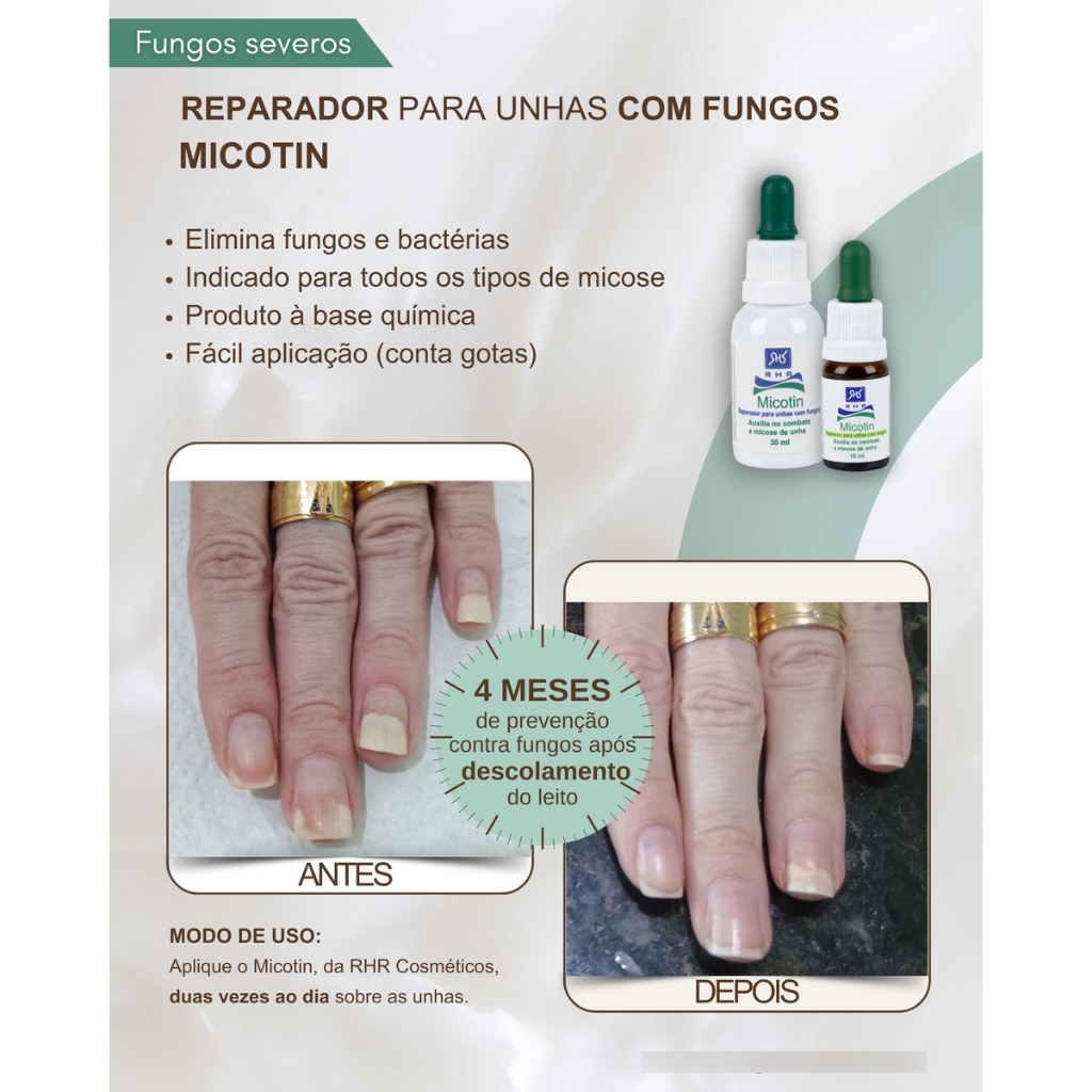 Micose Para Unhas Micotin 30ml e 10 ml Conta Gotas - Reparador Para Unhas Com Fungos - Escolha o seu