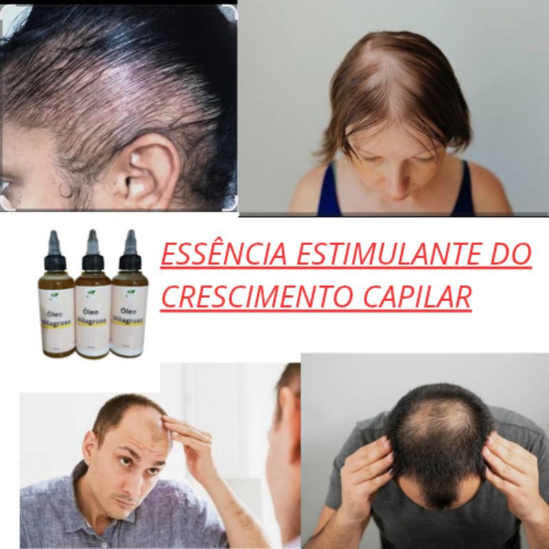 Óleo ALECRIM ! Óleo Essencial ANTI-QUEDAS 100% Natural Para Crescimento de Cabelos Capilar e *Fortalecimento*