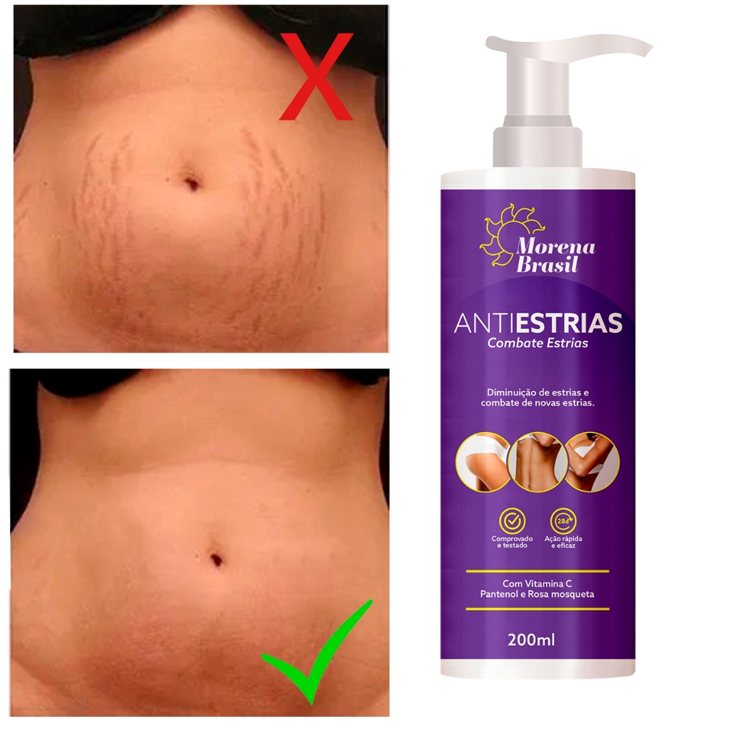 O que é Creme Corporal Anti Estrias? Guia e Onde Comprar | BuscaProdutos