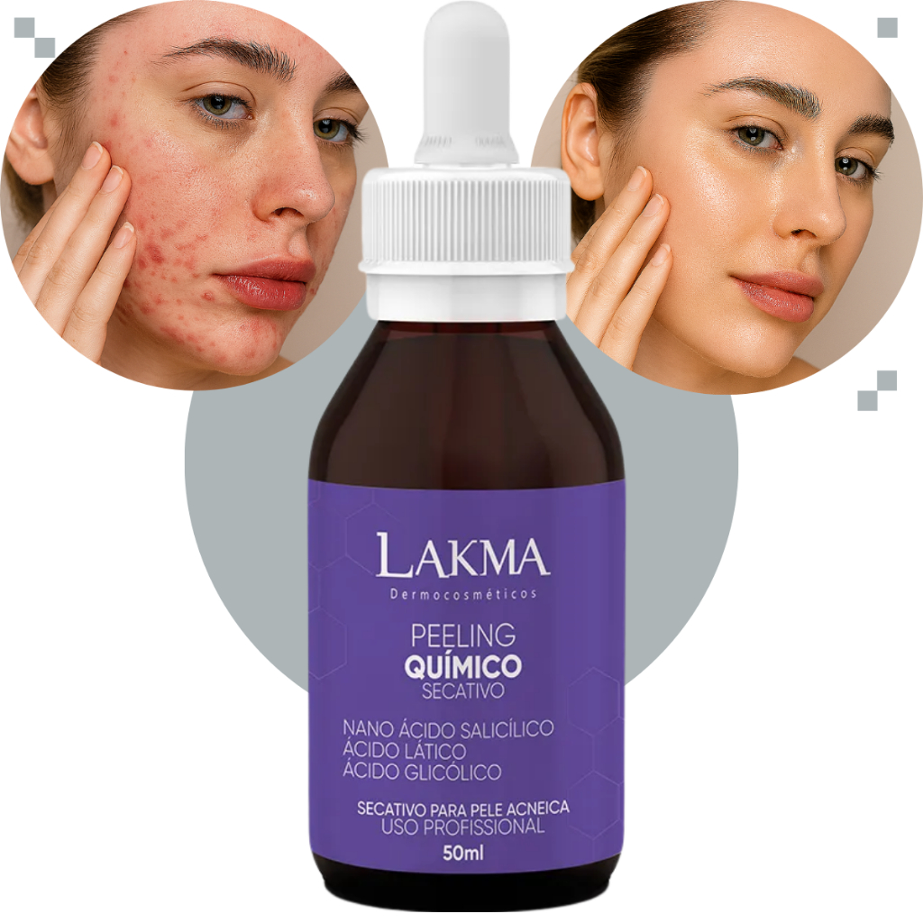 Peeling Químico 50ml Secativo Marcas Acne e Cravos Lakma Pele Oleosa