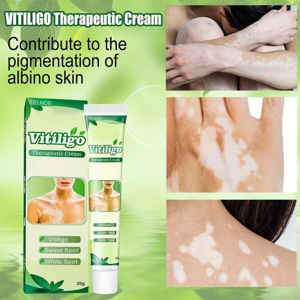 Sumifun 20g Creme De Vitiligo Pomada De Tratamento Reguladora E Melhora Pontos Brancos Na Leucoplasia Da Pele em Oferta na Shopee