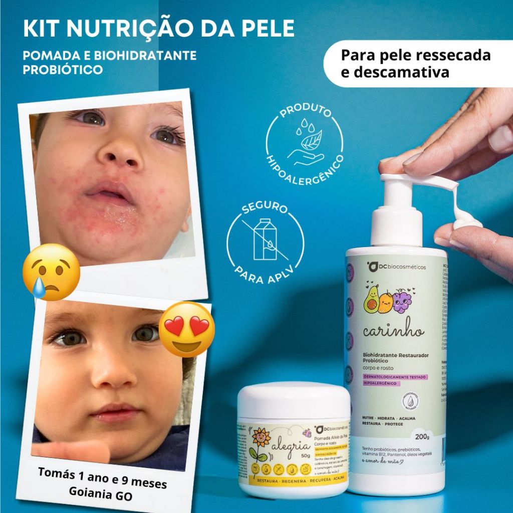 Pomadas Cremes para Psoríase: Onde Comprar | BuscaProdutos