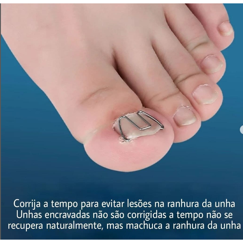 Corretor  Para Unhas  Encravadas Dedo