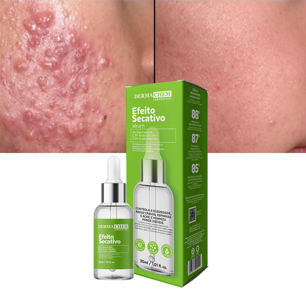 Sérum Efeito Secativo 30ml Dermachem controle de oleosidade, Reduz cravos, espinhas, acne e minimiza poros visíveis em Oferta na Shopee