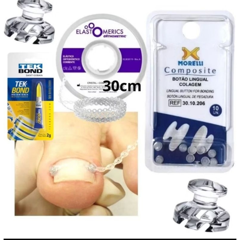 Kit Botão Transparente para unha encravada + Cola e Elástico Corrente em Oferta na Shopee