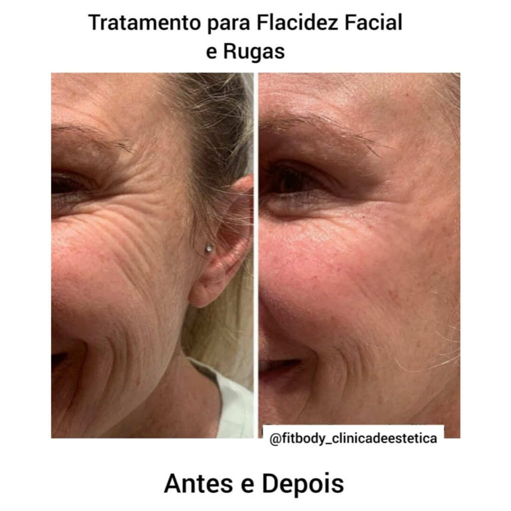 Creme para Flacidez do Rosto: Onde Comprar | BuscaProdutos