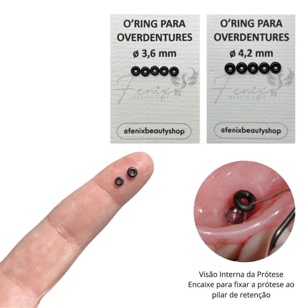O-RING RETENÇÃO DO IMPLANTE ATTACHMENT BOLA MINI BORRACHINHA OVERDENTURE ODONTO 1,78 3,6mm 4,2mm ORING O'ORING