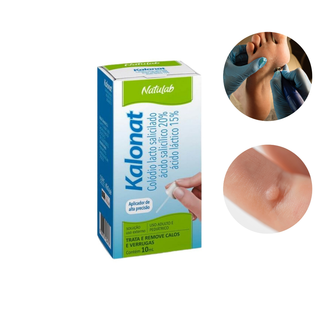 Kalonat Calicida Calos e Verrugas 10mL em Oferta na Shopee