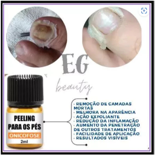 PELLING PARA PODOLOGIA, REMOÇÃO DE ONICOFOSES 2 ML