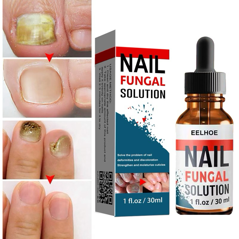 tratamento de micose e fungos  branca