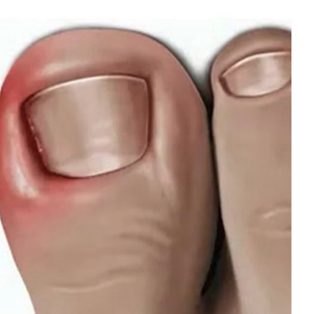 Essência De Tratamento Fúngico Para Unhas Dos Pés Anti-Infecção Paroníquia Das Gel Nutritiv Remoção De Fungos preta