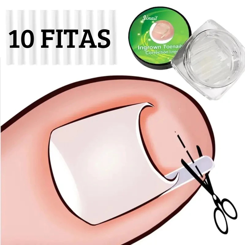 Fita Órtese Desencravar Unha Encravada Corretora 10 Peças em Oferta na Shopee