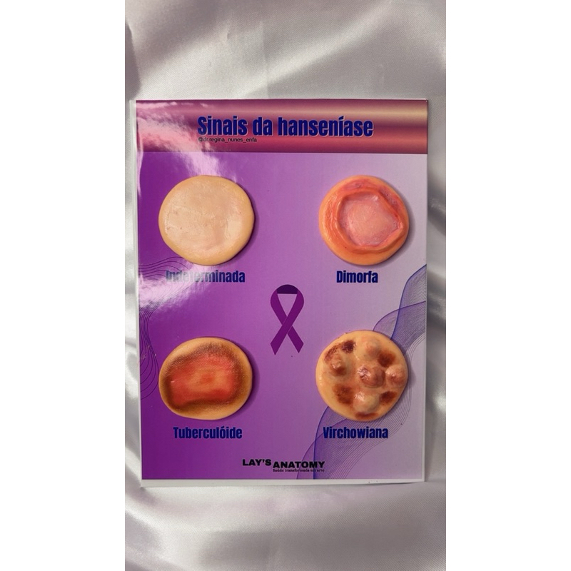 Macromodelo - Sinais de hanseníase