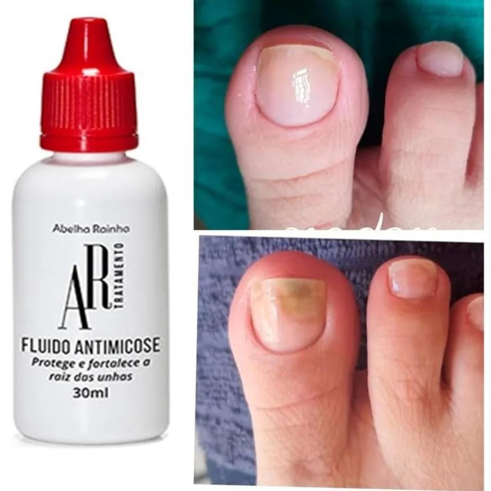 Fluido Anti Micose Para Unhas e Pés AR Tratamento Abelha Rainha 30ml | Combate Fungos e Fortalece as Unhas - 8296 em Oferta na Shopee