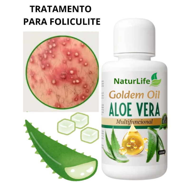 Tratamento Psoríase Óleo de Babosa 100ml - Cure, Hidrate e Proteja Sua Pele