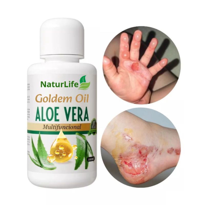 Tratamento Psoríase Óleo de Babosa 100ml - Cure, Hidrate e Proteja Sua Pele