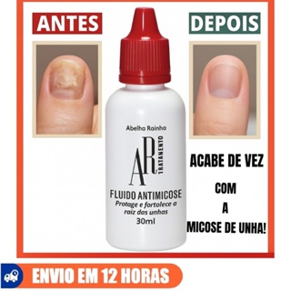 Fluido Anti Micose Remedio para unhas com fungos Melaleuca Abelha Rainha 30 ML micose de unha em Oferta na Shopee
