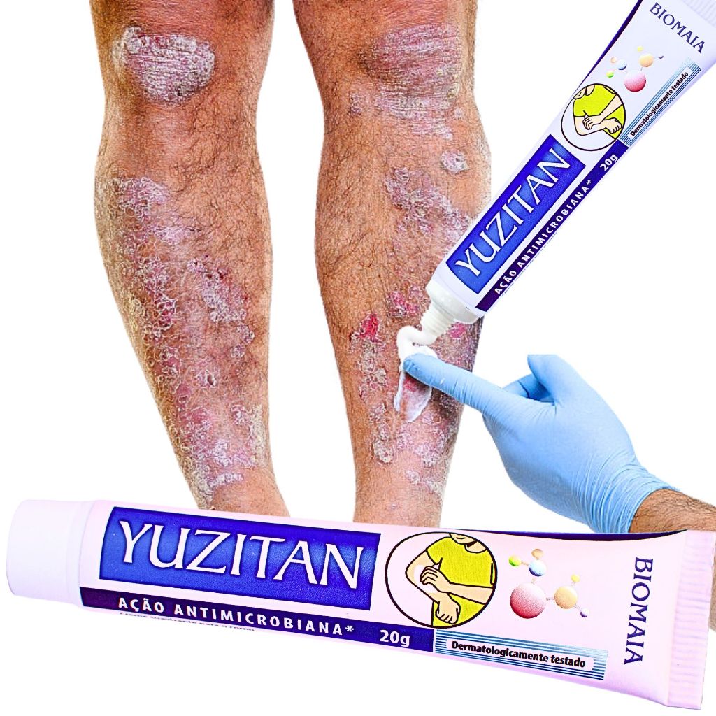Antialérgico Para Dermatite E Coceiras Psoriase Corporal 20g em Oferta na Shopee