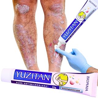 Antialérgico Para Dermatite E Coceiras Psoriase Corporal 20g em Oferta na Shopee