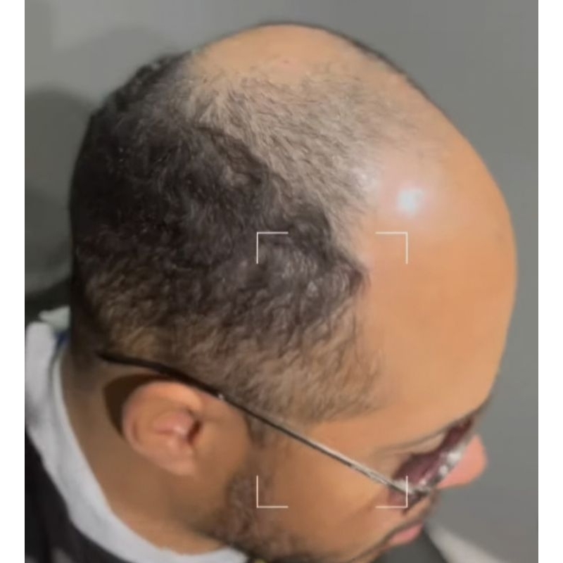 prótese capilar afro masculina topo todo
