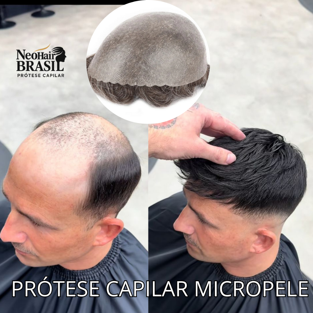 Prótese Capilar Micropele masculina com cabelo humano premium: naturalidade total e conforto absoluto