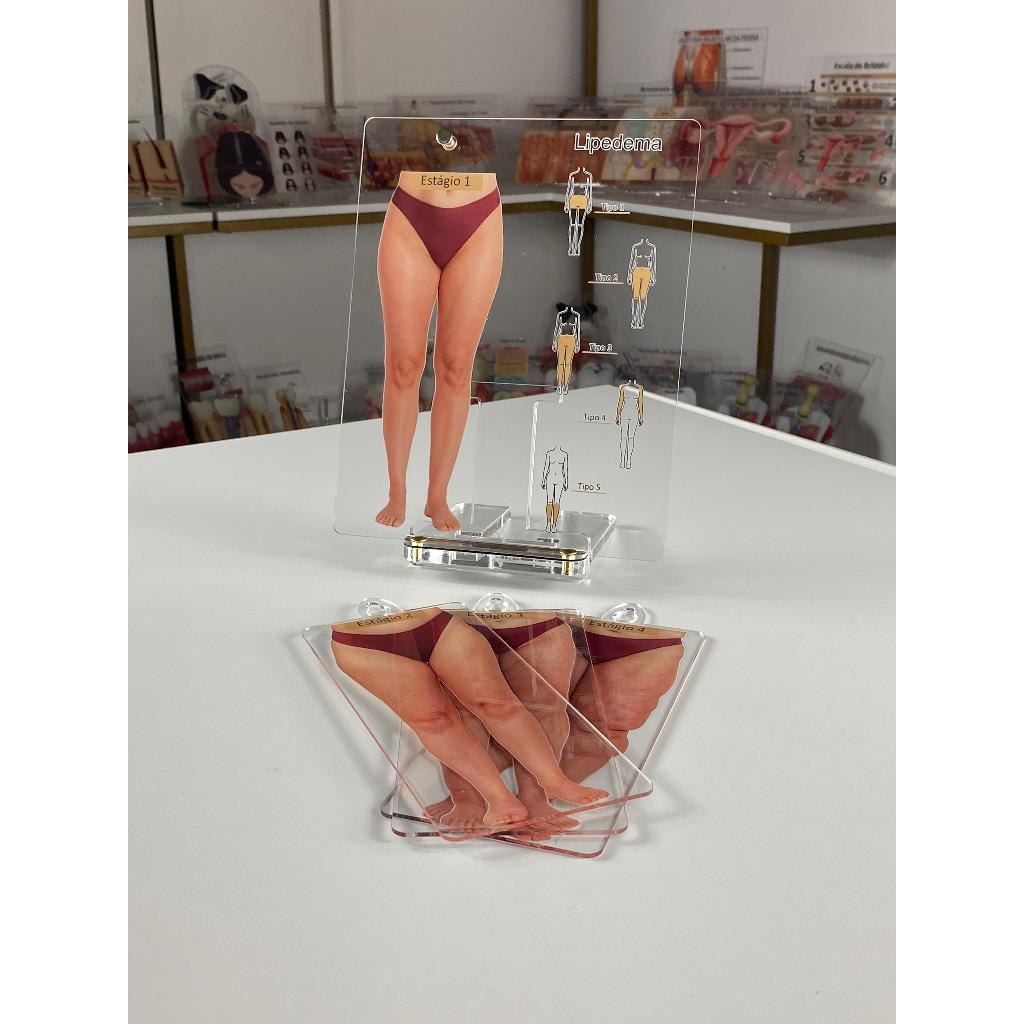 Quadro De Marcação - Lipedema Dermatologia Cuidados com a pele Macromodelo