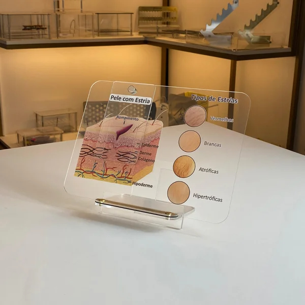 Quadro De Marcação - Tipos De Estrias Macromodelo cuidados com a pele