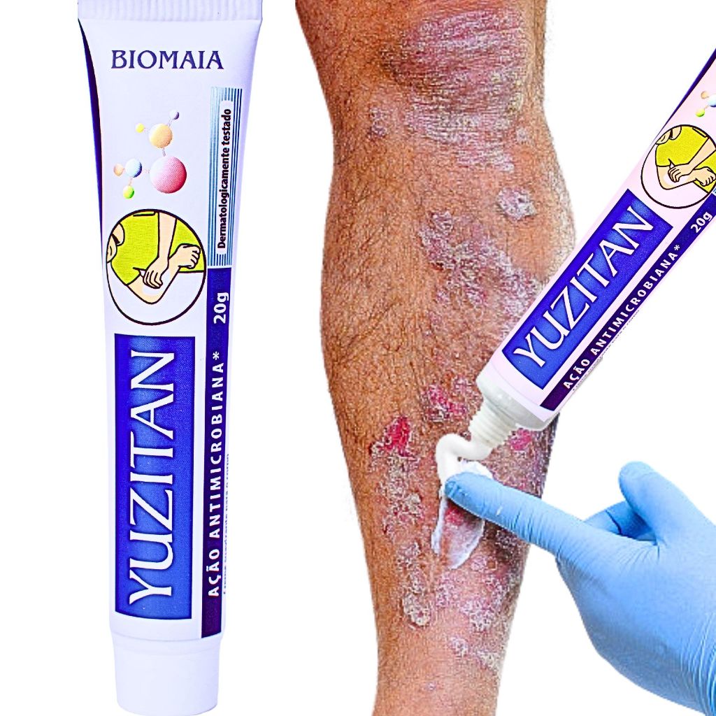 Pomada p/ Psoríase e Dermatite com Alívio p/ Coceira Descamação - Pomada refrescante 20g em Oferta na Shopee