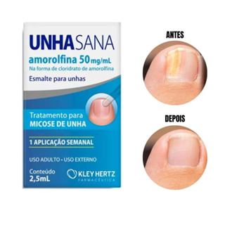 Unhasana Esmalte Amorolfina Tratamento para Micose de Unha e Fortalecimento 2,5ml em Oferta na Shopee
