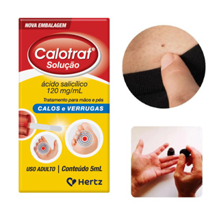 Calotrat 5ml Anti Verrugas Calos Calosidades em Oferta na Shopee
