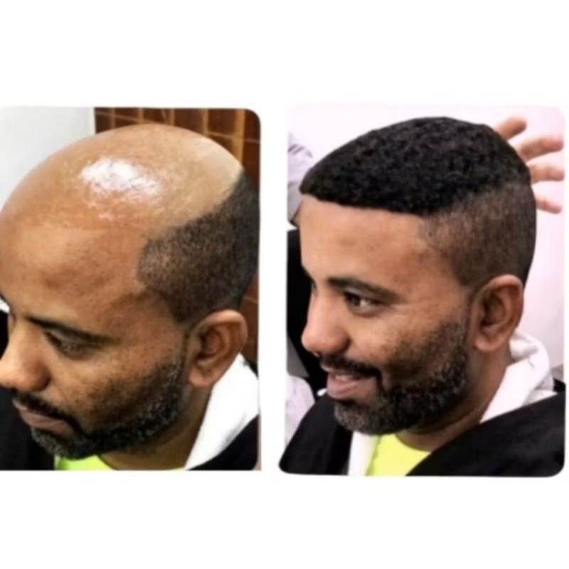 PRÓTESE CAPILAR AFRO MASCULINA DIGA ADEUS A CALVÍCIE