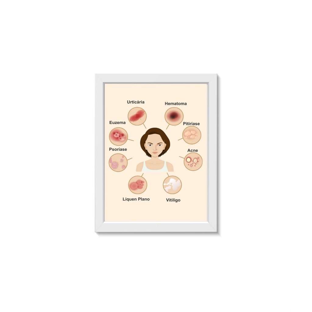 Quadro Decorativo Doenças da Pele Dermatologia Medicina Moldura 20x30cm Madeira Vidro Branca