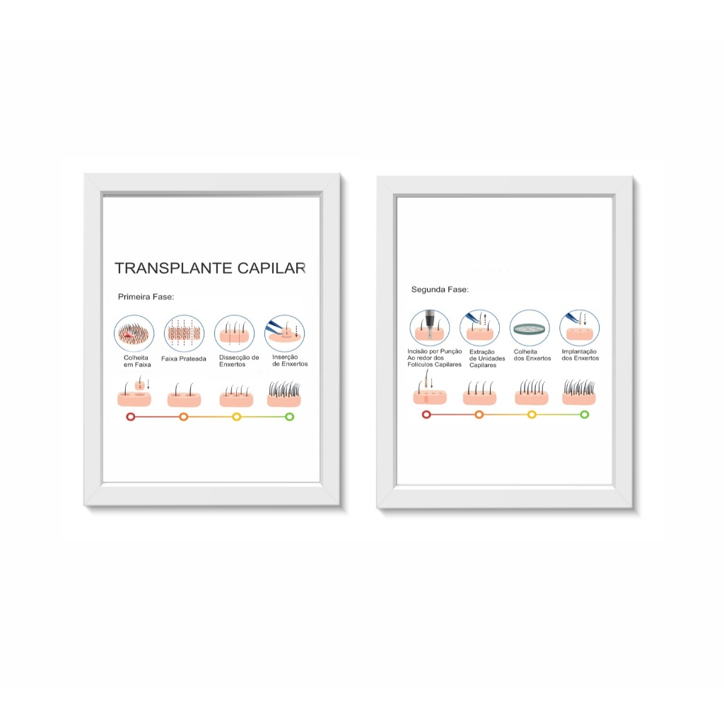 Kit 2 Quadros Decorativos Transplante Capilar 30x40cm Molduras Madeira Vidro Brancas
