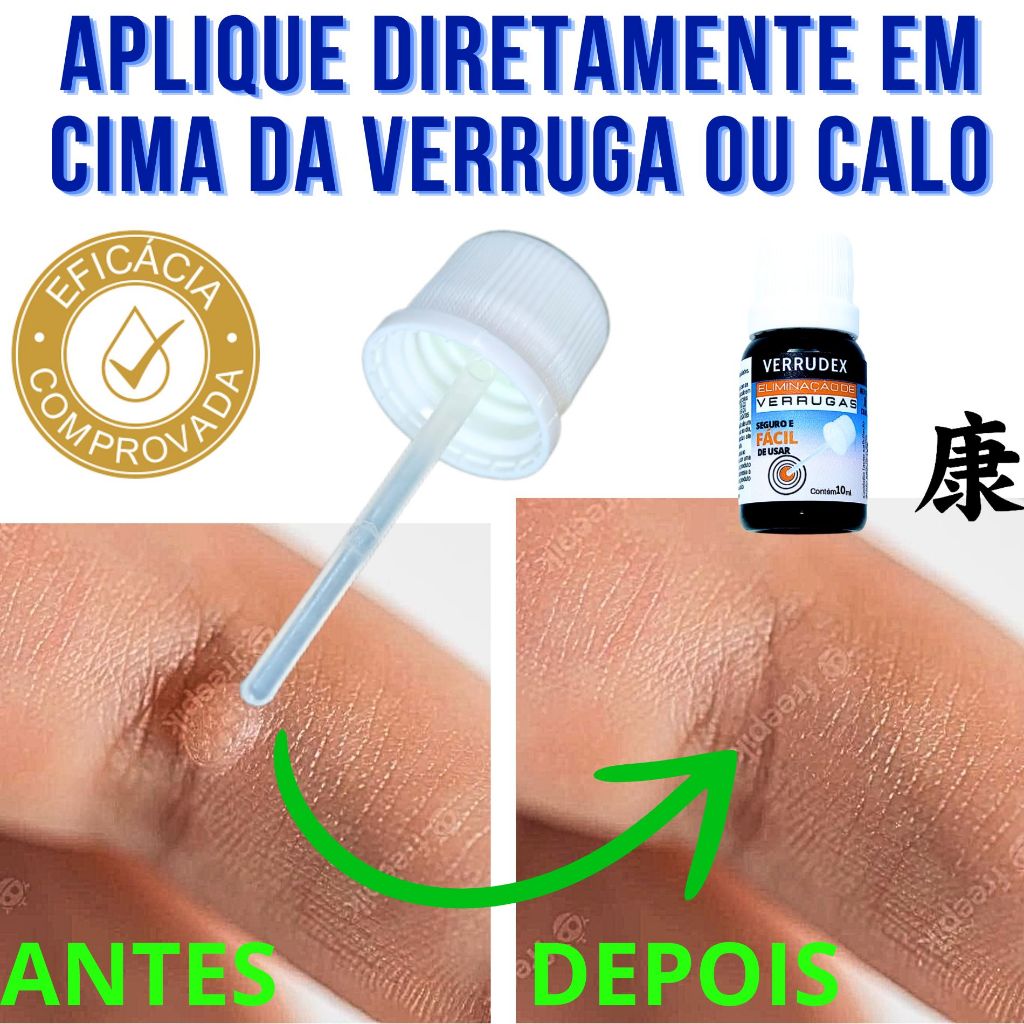 Cuidado tópico para pele com verruga e sensibilidade local