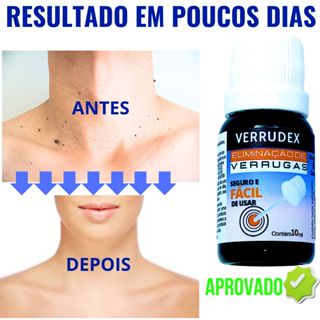Verruga externo para cuidado da pele com verrugas e desconfortos em Oferta na Shopee