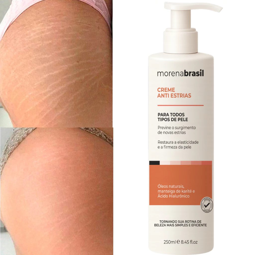 Creme AntiEstrias Removedor Estrias 200g Morena Brasil – Ação Poderosa com Colágeno e Elastina