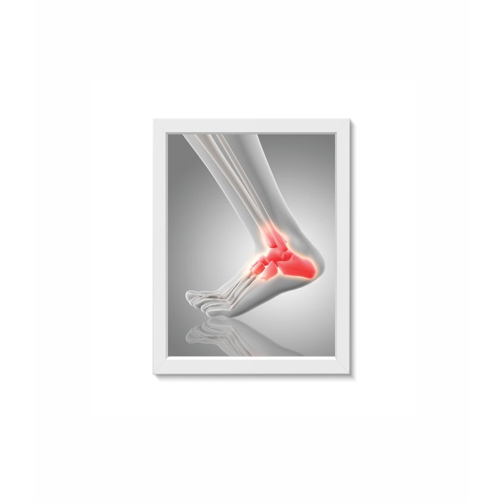 Quadro Decorativo Calcanhar Ortopedia Reumatologia Medicina Fisioterapia Moldura 20x30cm Madeira Vidro Branca