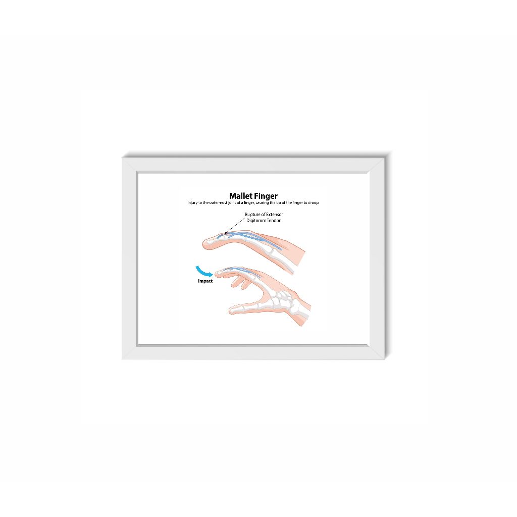Quadro Decorativo Mão Dedo Decoração Consultório Médico Ortopedia Reumatologia e Fisioterapia Moldura 30x20cm Madeira
