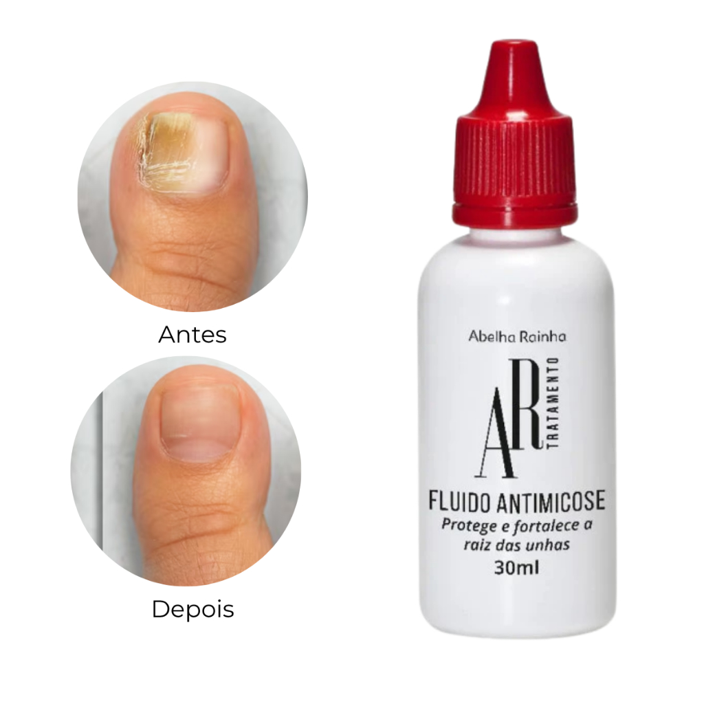 Fluido Anti Micose Para Unhas Tratamento Fungos nas Unhas Remédio Abelha Rainha 30ml Micose de Unha
