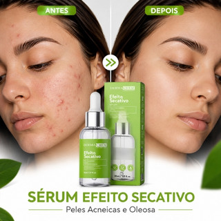 Sérum Secativo Para Peles Oleosas Com Acne E Cravos Dermachem- Efeito Secativo