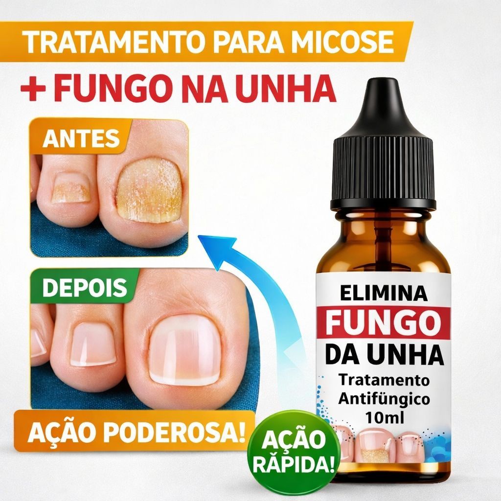 Removedor de Micose na Unha Tratamento Fungos Unha Pé e Mão Antifúngico Elimina Fungos 10ml branca em Oferta na Shopee