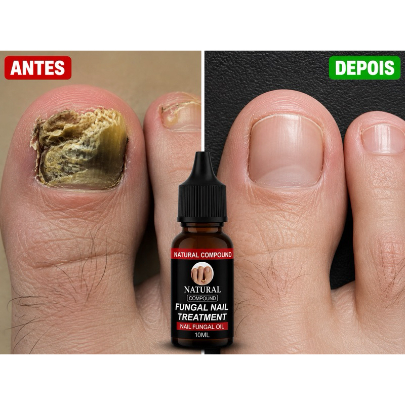 TRATAMENTO PARA MICOSE DE UNHA  ACABE COM O FUNGO DAS UNHAS preta 10ml