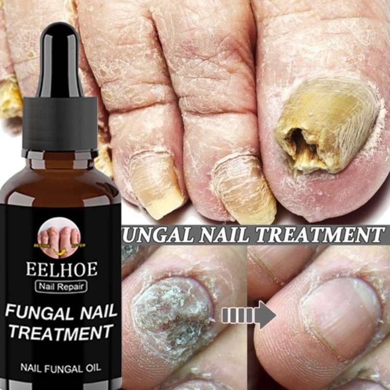 1 FRASCO ⬇️ TRATAMENTO⬇️ PARA UNHA micoses SAUDAVEIS 30ml
