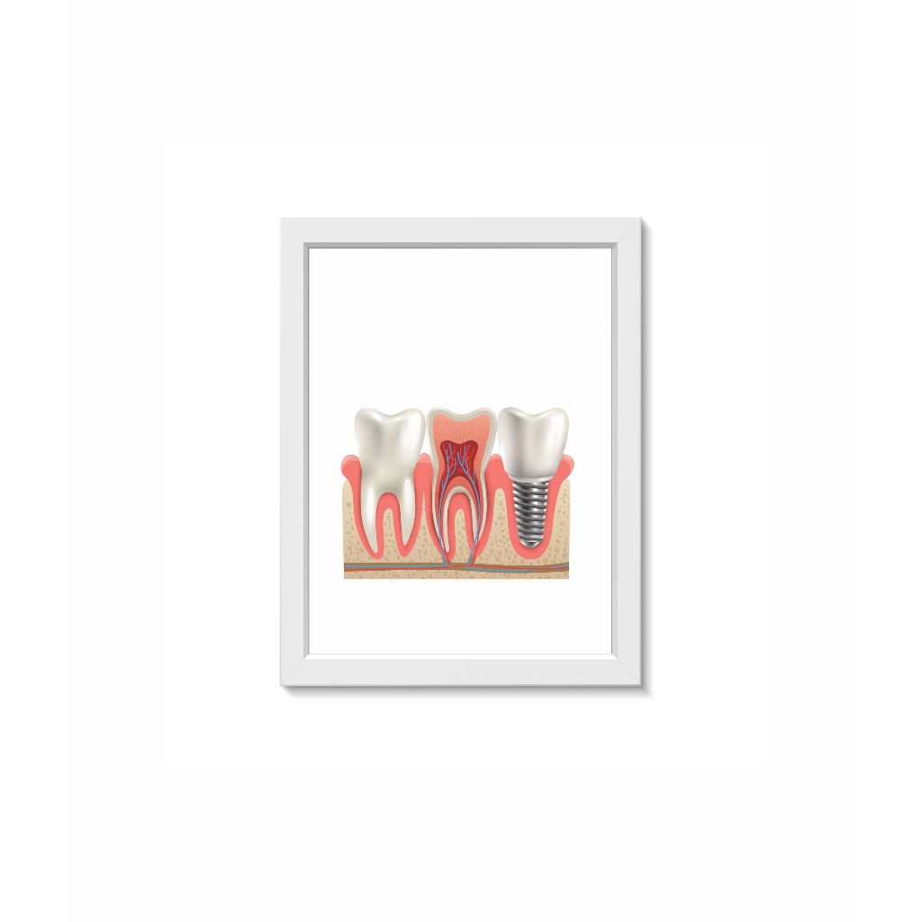 Quadro Decorativo Implante Dentário Odontologia Consultório Clínica Moldura 30x40cm Madeira Vidro Cor Branca