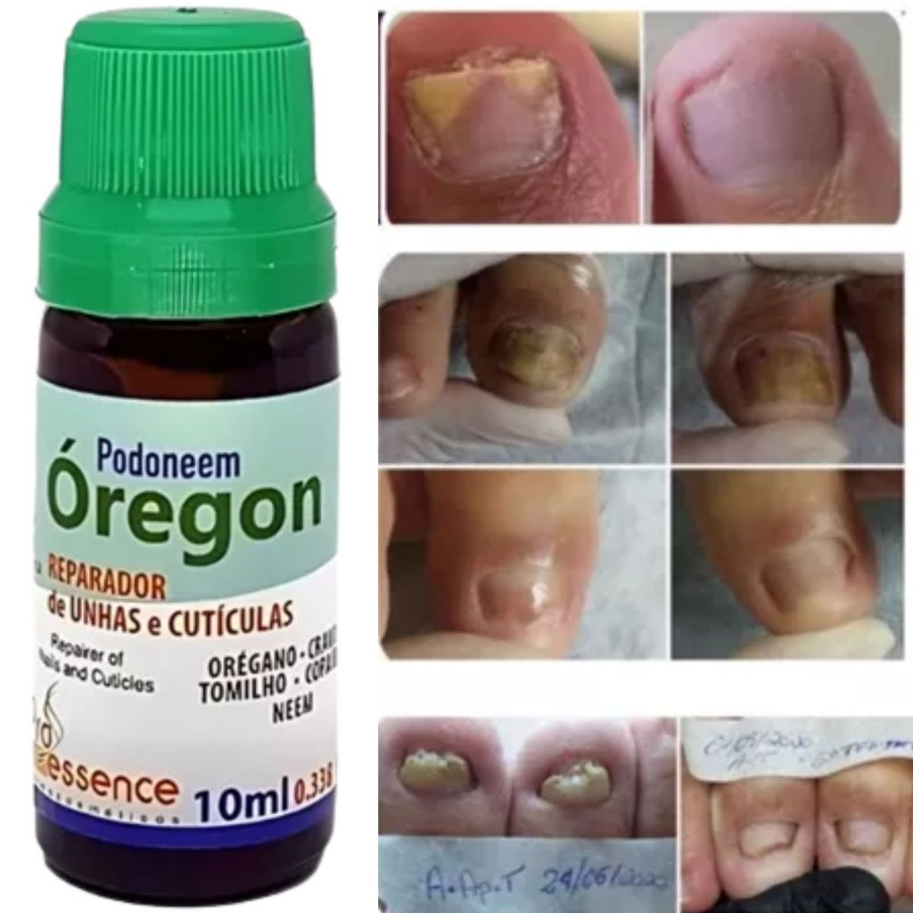 Reparador De Unhas E Cutículas Podoneem Óregon 10ml Pró Essence