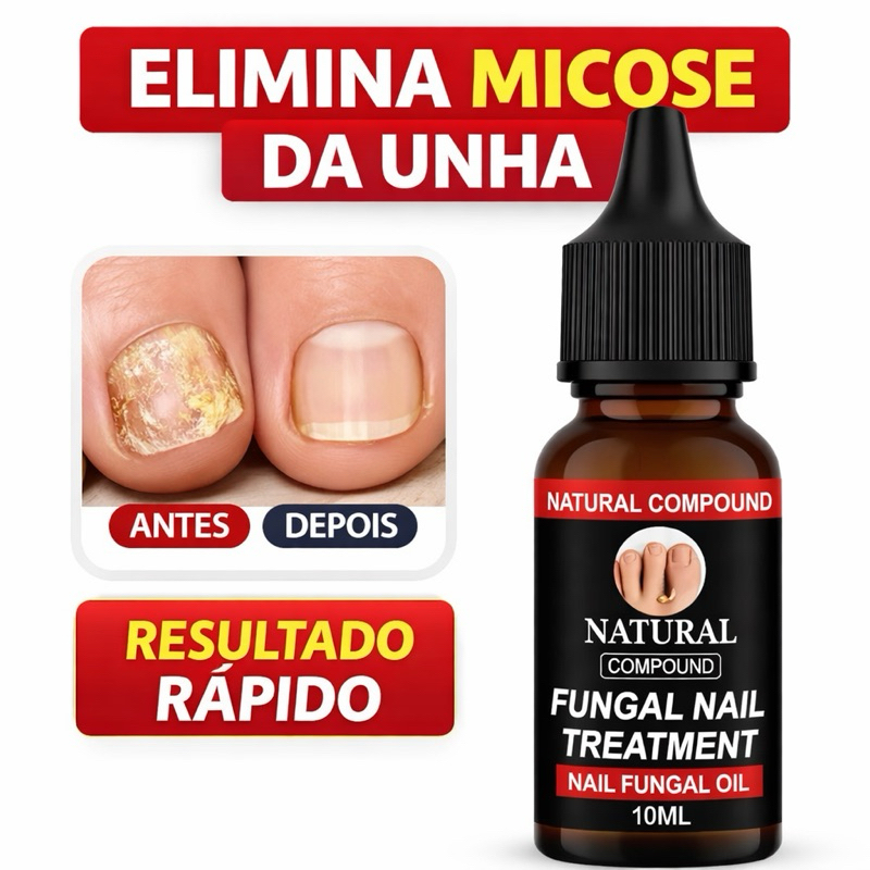 1 Elimina Micose da Unha Tratamento Antifúngico Forte Removedor de Fungos Unha Pé10ml preto