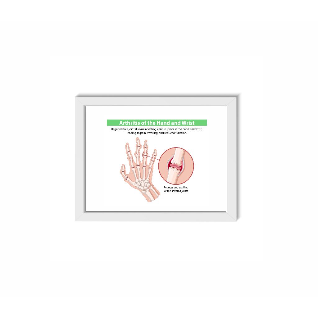 Quadro Decorativo Artrite Mão e Pulso Ortopedia Reumatologia Medicina Moldura 30x40cm Madeira Vidro Cor Branca