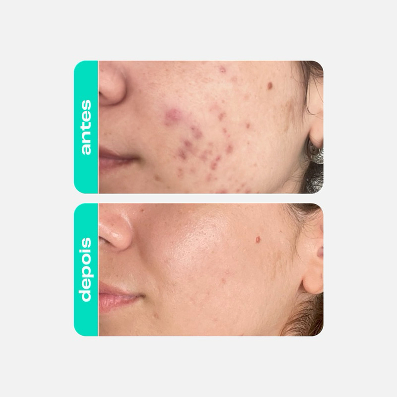 Gel Creme Retexturizador Antioleosidade - Glicointense Peel - Creamy Skincare - 30G