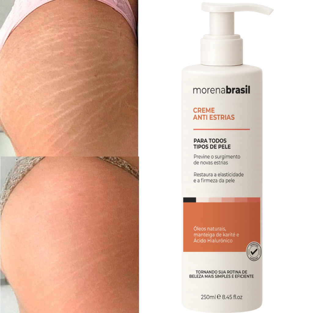 Creme Anti-Estrias Morena Brasil - Ação Poderosa com Colágeno e Elastina!!